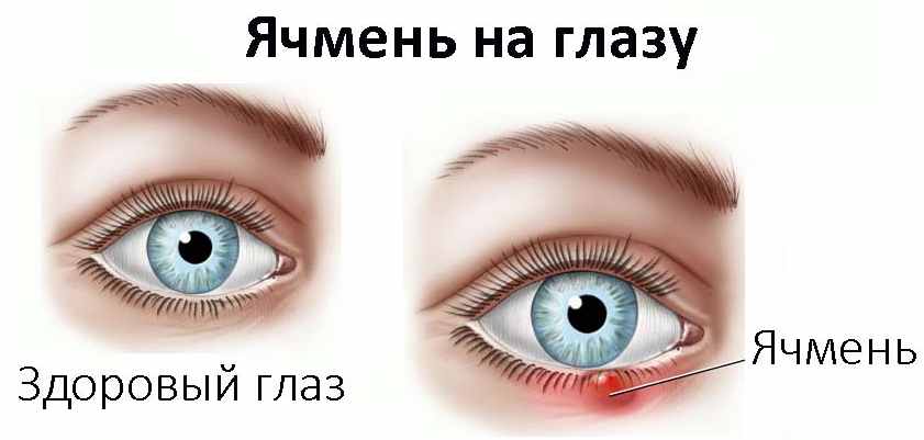 ячмень на глазу