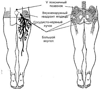 Определение верхненаружного квадранта ягодицы